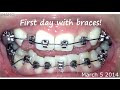 BRACES BEFORE AND AFTER TIME LAPSE