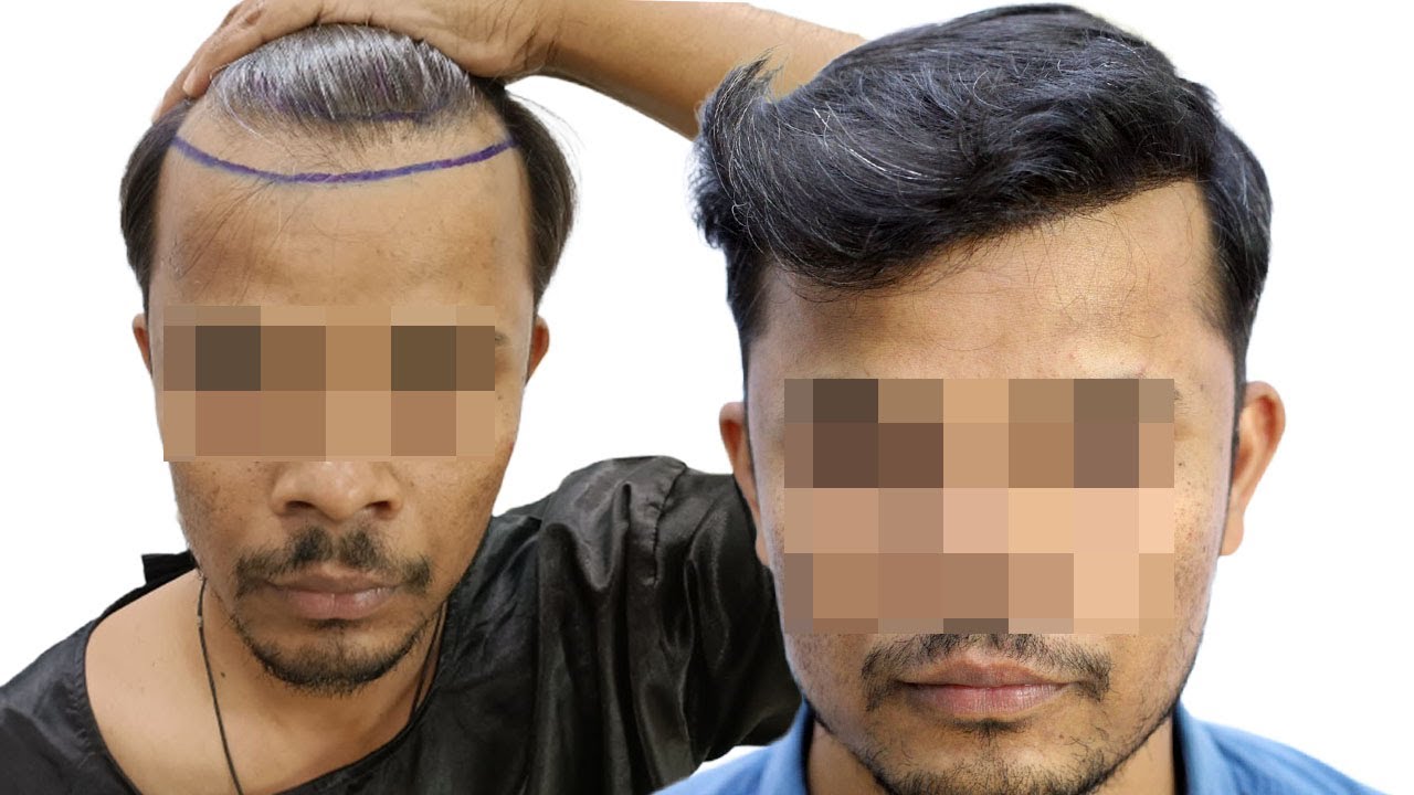 Best Hair Transplant Result In Raipur Hairline Lowering YouTube