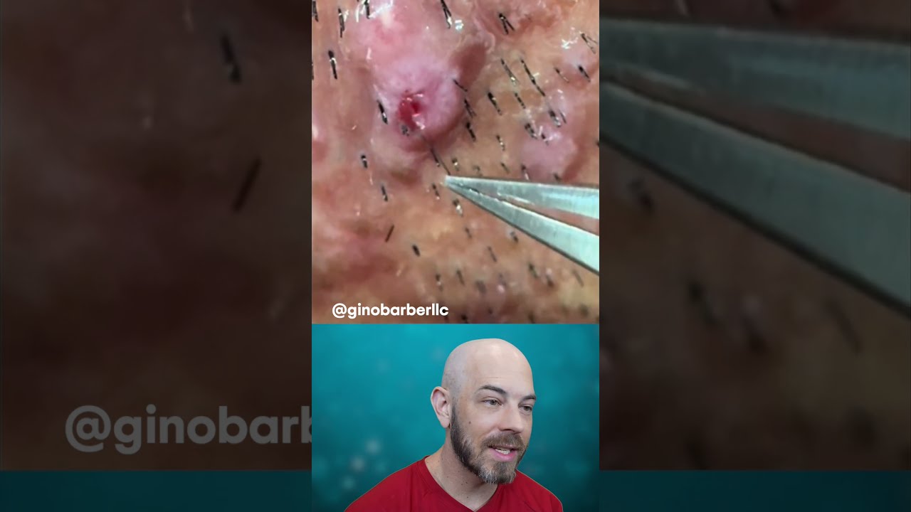 ULTRA Juicy Ingrown Hairs On The Back Of Neck Credit Ginobarberlic TT Plucking