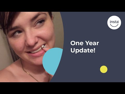 1-year-update!-when-instasmile-covered-4-missing-teeth-for-a-complete-smile-transformation