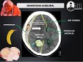 HEMATOMAS INTRACRANEALES EPIDURAL Y SUBDURAL  |  Como describir una Tomografía de cráneo