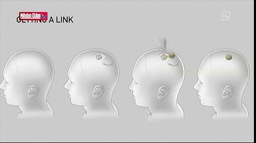 Cấy chip vào não người - Câu chuyện vẫn còn nhiều tranh cãi