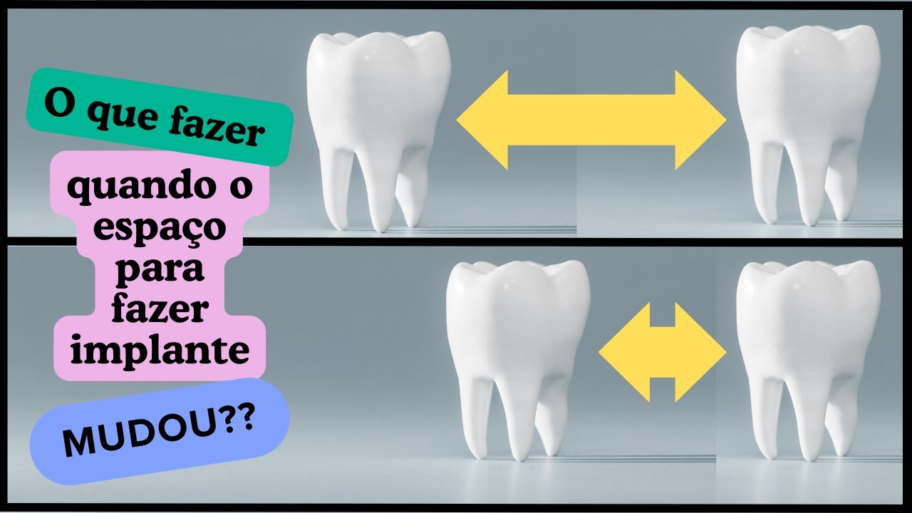 IMPLANTE DENTÁRIO -  O QUE FAZER QUANDO O ESPAÇO AUMENTA OU DIMINUI ?