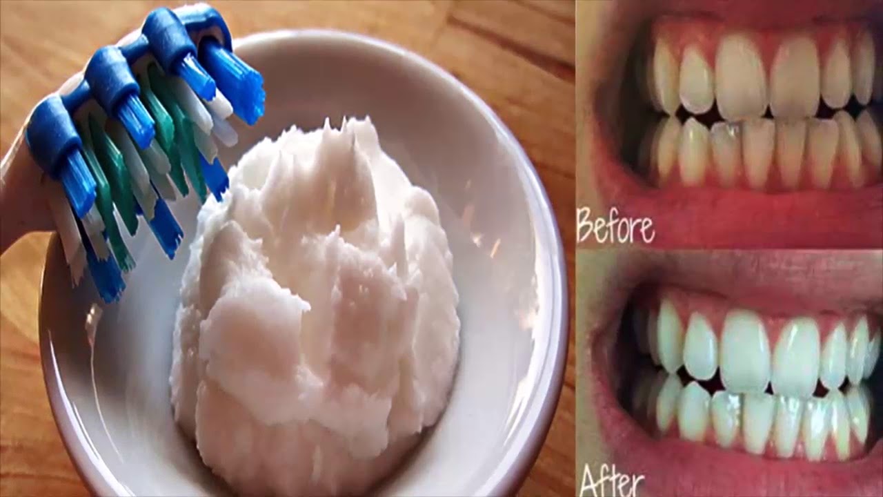 Coconut Oil Is Better Than Any Toothpaste According To New Study