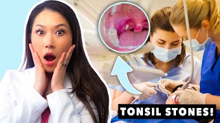 All About Tonsil Stones