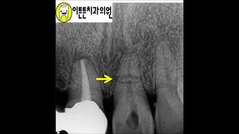 7-22-1.  윗앞니 외상 후 치아뿌리 부러짐으로 인해 발치, 임플란트 (부산 광안리 뉴욕치과)