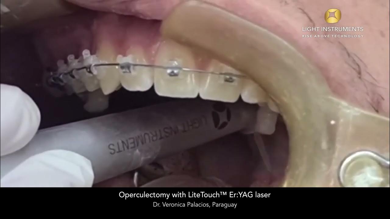 Operculectomy With Litetouch™ Eryag Laser Youtube