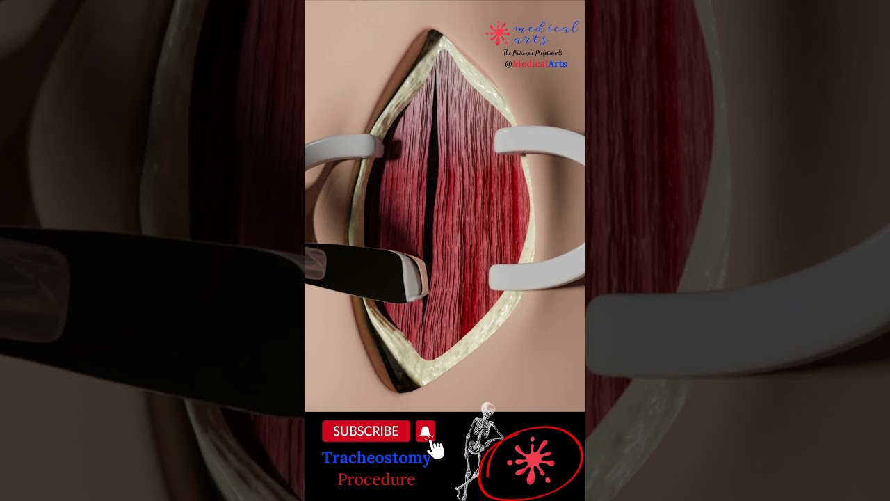 Tracheostomy Procedure 3D Animation