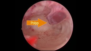 Hysteroscopic Polypectomy I Dr. Rajeev Agarwal