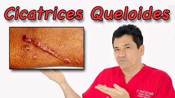 ¿Siguen creciendo los queloides?