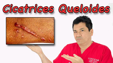 ¿Qué tipo de piel es propensa a los queloides?