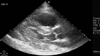 Arrêt cardio-respiratoire et échographie clinique