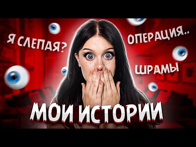 МОИ ИСТОРИИ! (операция, шрамы, я слепая?)