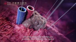 What is IRE NanoKnife ablation? Explained in 2 minutes
