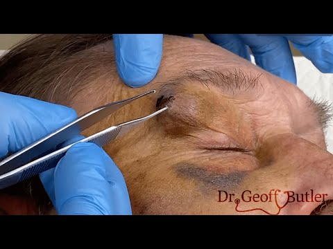Draining a facial hematoma