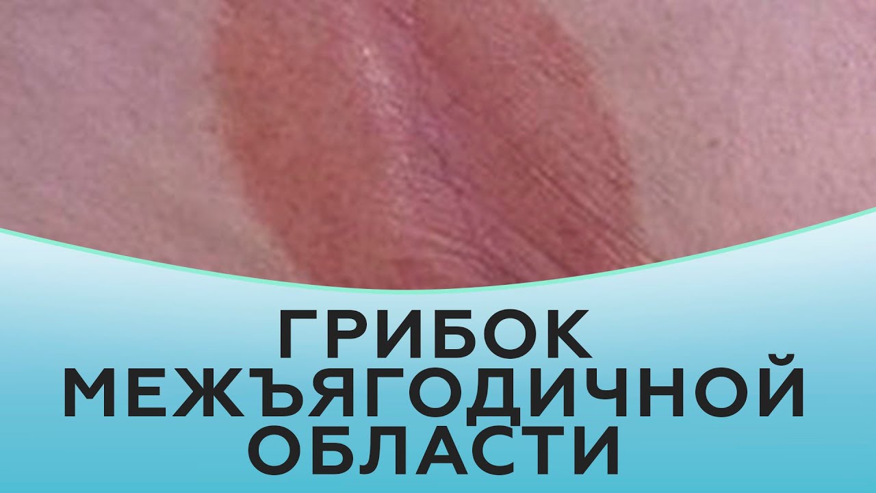 Гладкие, безупречные ноги с нашим кремом от потертостей: попрощайтесь с ...