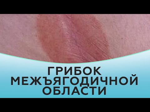 Симптомы и лечение потницы в детском возрасте и у взрослых