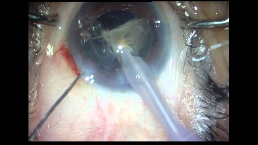 phacoemulsification