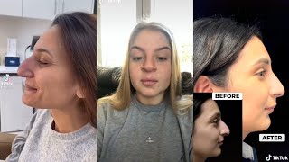 AMAZING NOSE JOB TRANSFORMATION 👃 TikTok Compilation