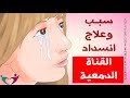 سبب وعلاج انسداد القناة الدمعية