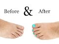 Toenail Treatment - Miracle Gelous Reconstruction