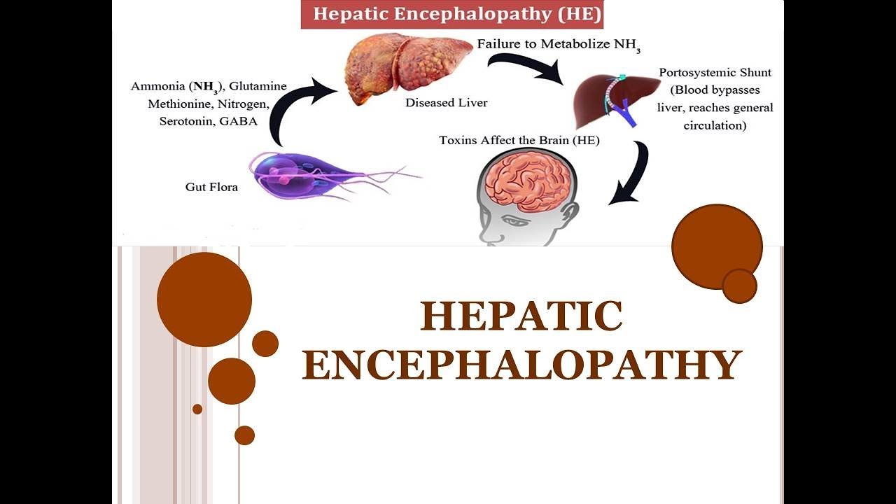 Hepatic encephalopathy and the real case study 🏥 - YouTube