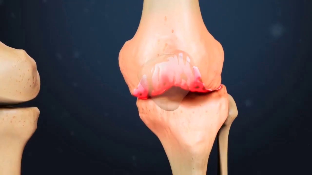 tratamentul artrozei deformante a articulației genunchiului