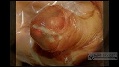 Gonorrea en Mujeres: Sintomas, Tratamiento y Causas, ¿Cuáles son los síntomas de la gonorrea?, ¿Qué es la gonorrea? ¿cuáles son los sintomas y tratamiento?, Primeros síntomas de la sífilis, ¡aprende a detectarla!, Sintomas de Tricomoniasis en Mujeres y Hombres, Causas, Contagio y Tratamiento