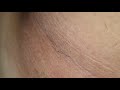 Epilating armpit upclose 🤪 (satisfying)
