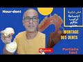 Montage des dents partielle haut       noureddinevlogsbr