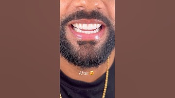 Before vs after Invisalign, whitening and composite bonding by Dr. Josh 🤩 #smiletransformation