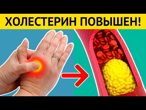 Вопрос: Как распознать признаки высокого уровня холестерина?