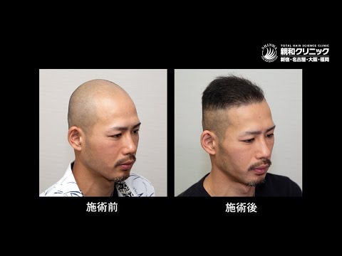 自毛植毛 の全てお見せします。 植毛 ・ 自毛植毛 体験