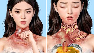 ASMR Remove Big Acne \& Maggot Infected Dirty Neck | Severely Injured Animation