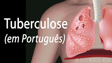 Como fica o pulmão de uma pessoa com tuberculose?