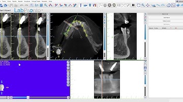 How to process the DICOM file in to Blue Sky Planner. Dr. Omid Termechi