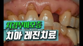 치아 치경부마모증 레진치료 [치아시림/시린이]
