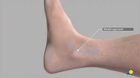 AO  Tibia and fibula–Malleolar fracture