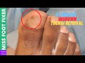 Stubborn Ingrown Toenail Treatment | Miss Foot Fixer | Marion Yau