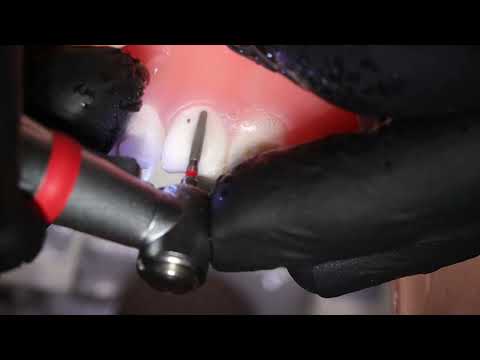 STOMBUDNI 56 Only 2 Burs For Crown Preparation 