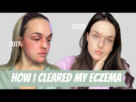 How I Cleared my Severe Eczema | Tips for Healing (re-upload)