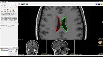 Analyze 15.0 - Segment: Manual Trace