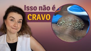 Como limpar os pontinhos pretos do nariz | Dica de Esteticista