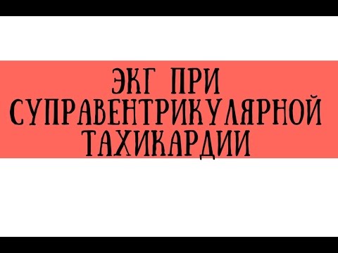 ЭКГ при синусовой тахикардии, фибрилляции и трепетании предсердий - meduniver.com