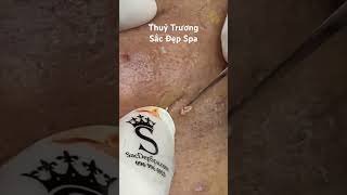 Acne Treatment  #thuytruong #sacdepspa