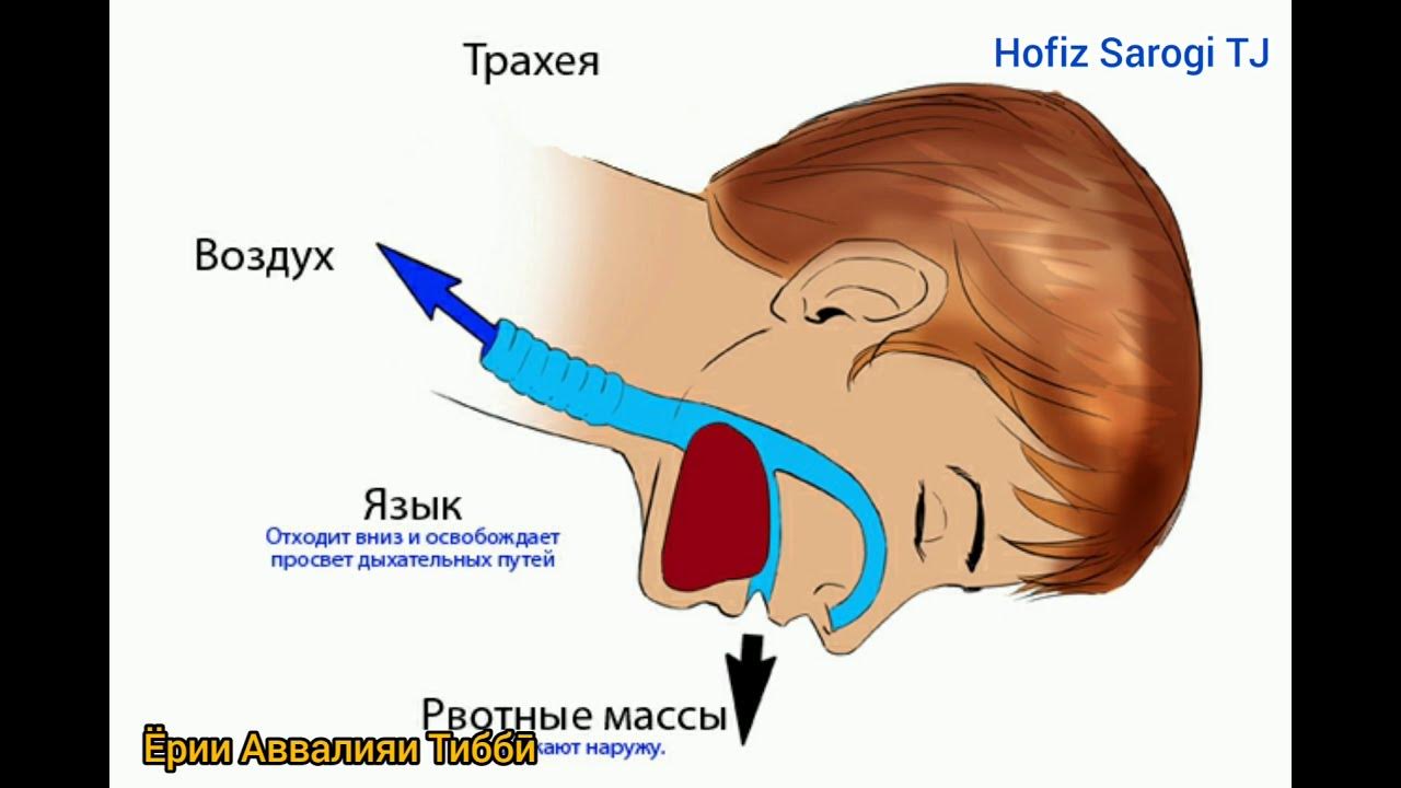 Рвотный рефлекс рвота. Аспирация рвотных масс. Рефлекторная рвота. Аспирация рвотных масс дыхательных путей.