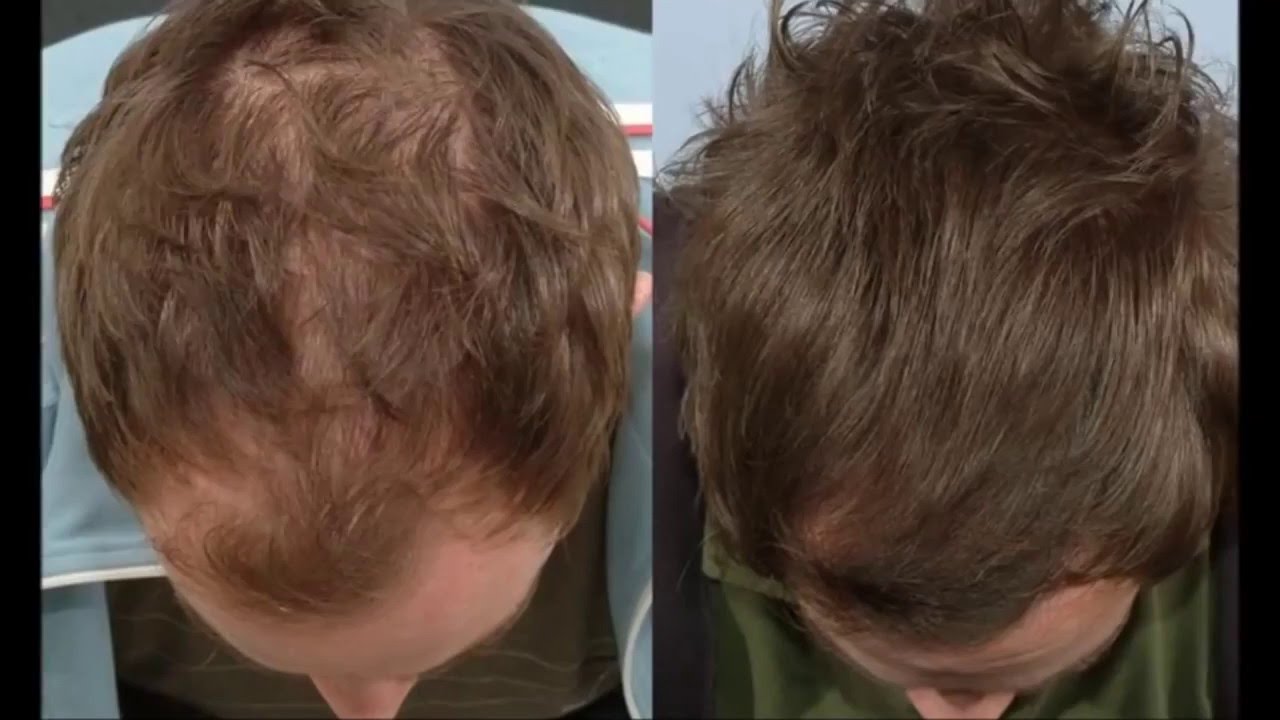 На волосах головы живут. Миноксидил финастерид до и после. Миноксидил для головы до и после волос мужчин.