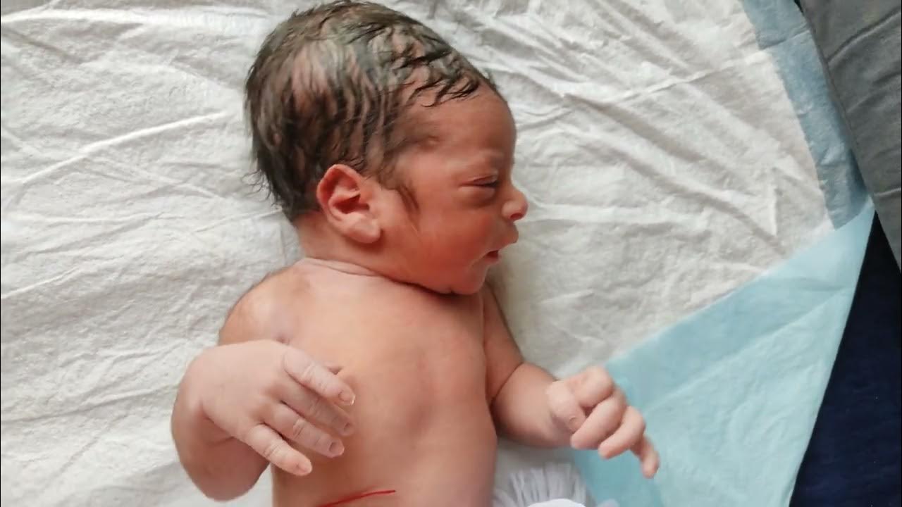 Cutest hairy newborn baby born with so much hair on body due to