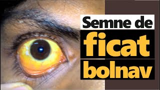 14 semne PE PIELE c? ai FICATUL BOLNAV