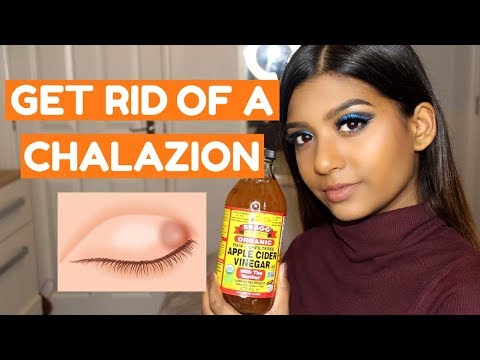 HOW TO GET RID OF A CHALAZION FAST AT HOME